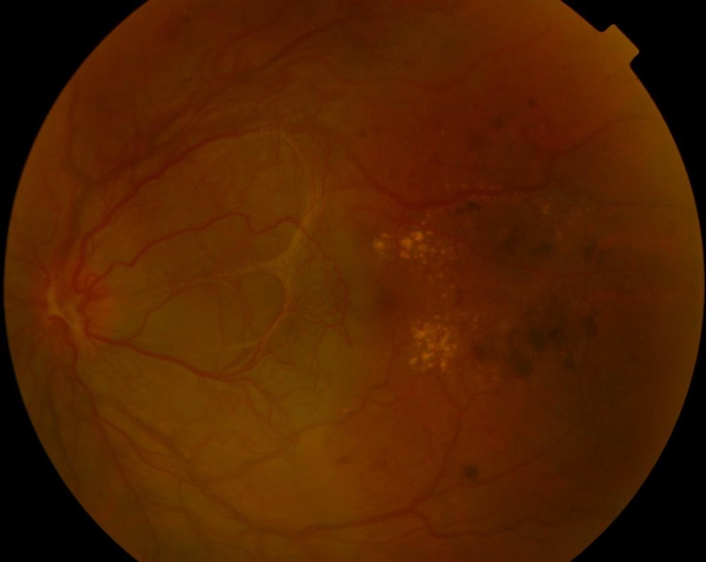 Retinopatia diabetica proliferante