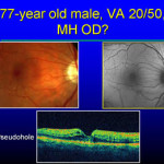 Figura 3 - Pseudoforo maculare. Si vede la presenza di una membrana epiretinica e la mancanza di un foro maculare a tutto spessore con l’OCT. L’autofluorescenza conferma la mancanza di un foro maculare completo.