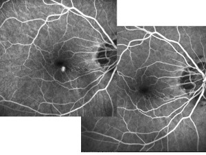 CNV miopica prima (a sin) e dopo (a dx) una iniezione intravitreale di anti-VEGF