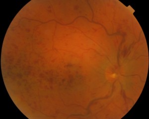 Figura 1: Occlusione venosa centrale della retina