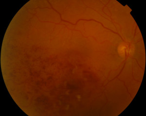 Figura 2: Occlusione venosa retinica di branca