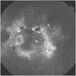 Fluorangiografia in CSC cronica.