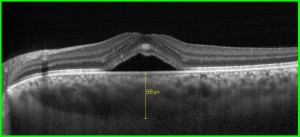 Scansione OCT in CSC acuta.