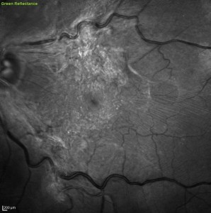 Figura 4. Membrana epiretinica trazionale benvisibile sulla superficie retinica all’immagine a luce verde