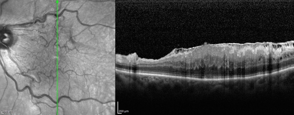 Figura 5. Immagine OCT di membrana epiretinica idiopatica sulla supeficie retinica associata ad edema maculare.