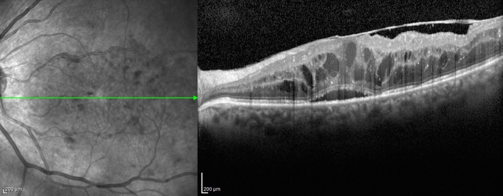 Figura 6. Immagine OCT di membrana epiretinica secondaria a retinopatia diabetica associata a cisti intarretiniche.