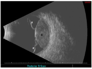 Fig. 3: Ecografia B-Can - melanoma della coroide cupoliforme (*) associato a distacco sieroso della retina perilesionale (#).
