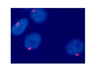 Fig. 6: Cellule di melanoma coroideale (ovali azzurri) analizzate con tecnica FISH (Fluorescence in-situ Hybridization). Queste cellule sono caratterizzate da una monosomia del cromosoma 3, cioè un solo cromosoma 3 (singolo puntino rosso all’interno di ogni cellula), invece che due cromosomi 3 come tutte le cellule normali (sarebbero visibili due puntini rossi per cellula).