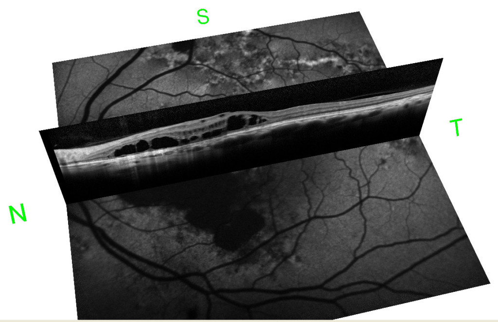 OCT e Autofluorescenza in caso di corioretinopatia sierosa centrale cronica (degenerazione maculare cistoide)