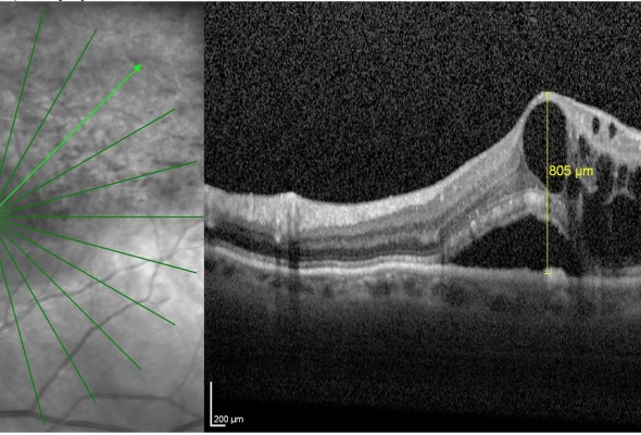 Edema maculare da occlusione venosa retinica: cosa fare