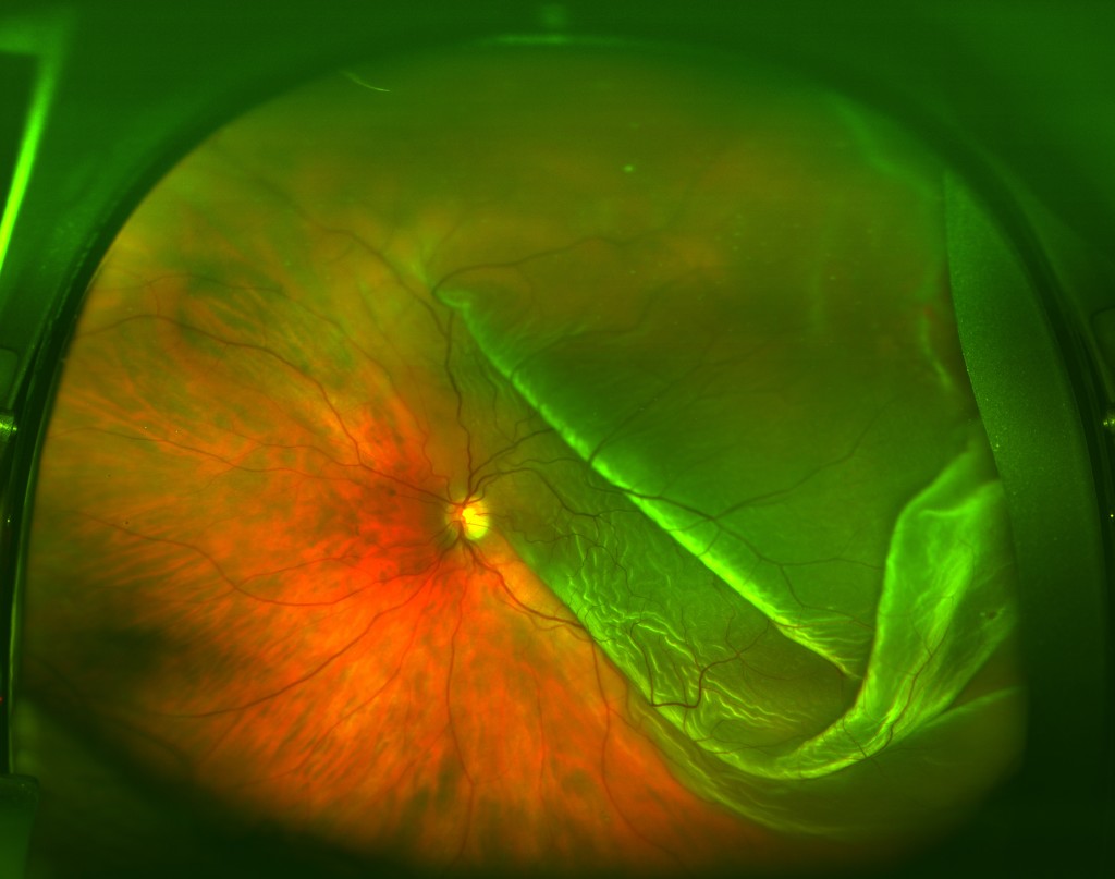 Retina parzialmente distaccata con coinvolgimento della macula (macula-off)