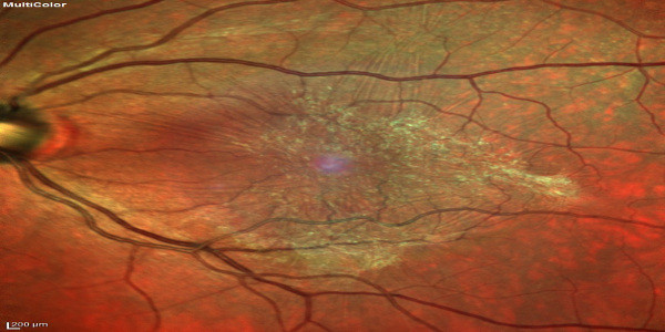 Distacco di Vitreo e Membrane Epiretiniche Maculari