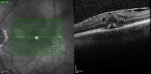 OCT in edema maculare infiammatorio associato a membrana epiretinica