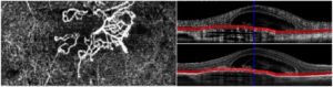 Angiografia-OCT di una neovascolarizzazione coroideale in un soggetto affetto da degenerazione maculare legata all'età. L'esame permette di definire nei dettagli la morfologia e l'esatta localizzazione della lesione senza l'infusione di colorante o mezzo di contrasto.