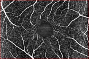 Angiografia-OCT del plesso capillare superficiale in regione maculare: la tecnica diagnostica permette di definire con estrema precisione i più fini dettagli riguardanti il microcircolo retinico a differenti livelli di profondità.